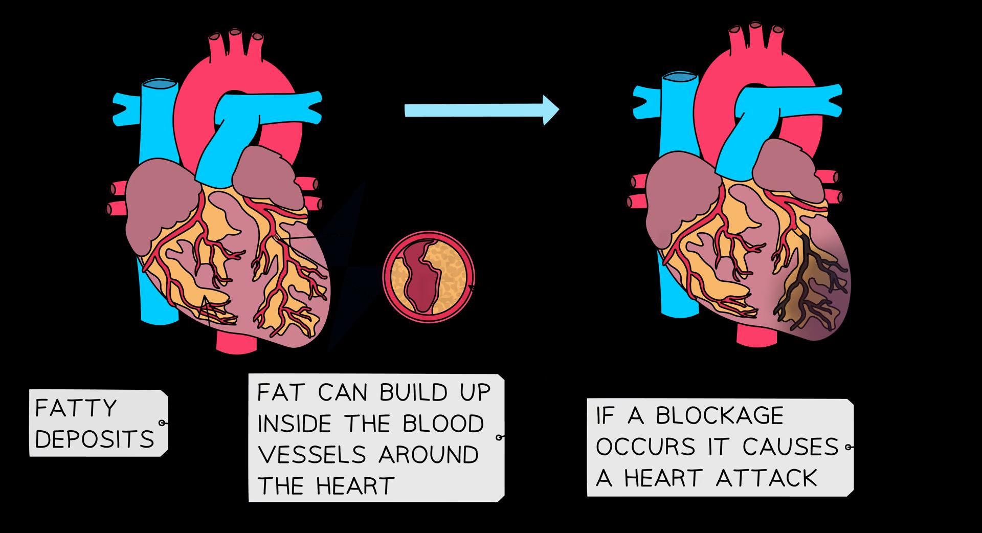 An artery with a fatty build up from cholesterol which leads to blockages in the coronary arteries and eventually heart attack